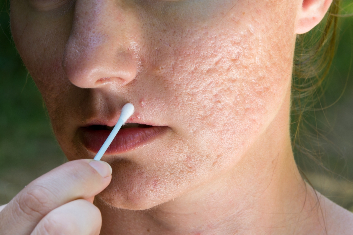 Desvendando os segredos da pele limpa: truques caseiros para minimizar a aparência da acne